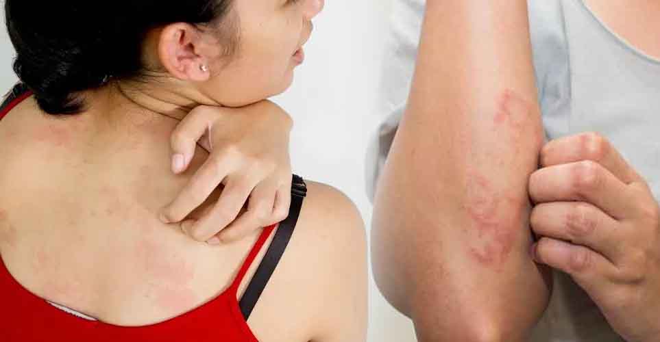 क्या होते हैं स्किन एलर्जी के कारण और लक्षण, आइए जानते हैं इस खबर में
